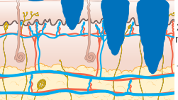 Melanoma Staging from the Wikipedia