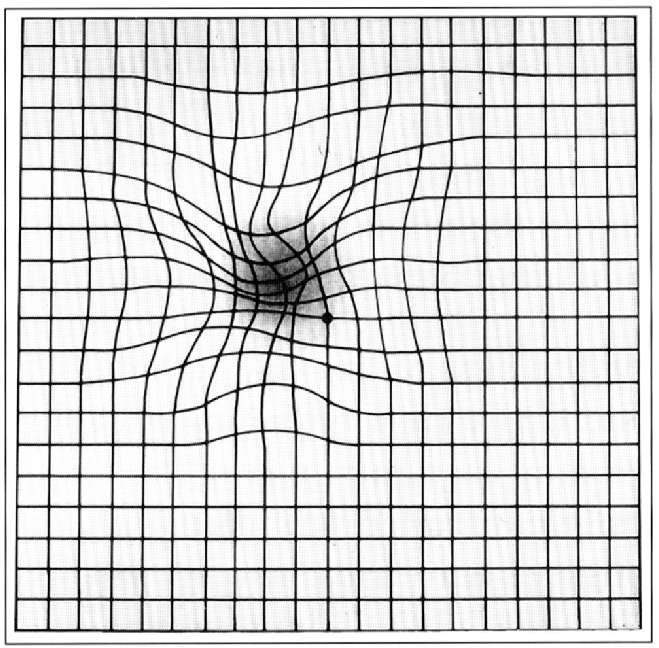 Distorted Amsler Grid Amsler grid as it might appear to someone with age-related macular degeneration Courtesy of National Eye Institute, National Institutes of Health